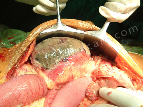 Caecal dilatation gangrene